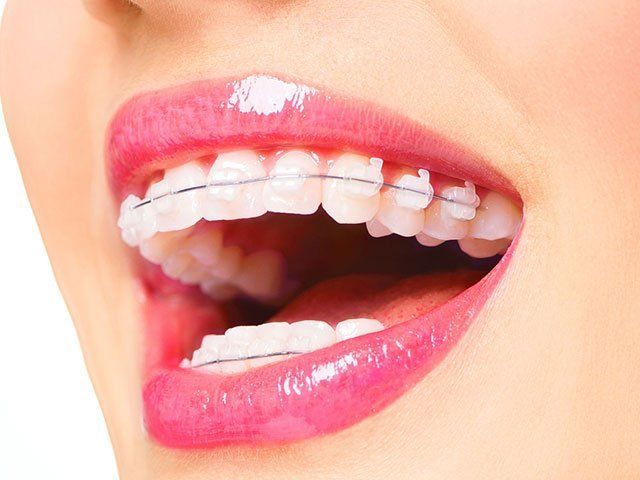 Teeth Alignment